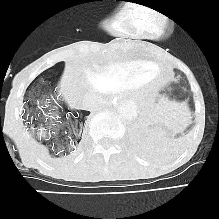 Clagett thoracotomy with bronchopleural fistula (Radiopaedia 29192-29587 Axial lung window 42).jpg