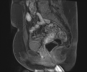 File:Class II Mullerian duct anomaly- unicornuate uterus with rudimentary horn and non-communicating cavity (Radiopaedia 39441-41755 G 56).jpg