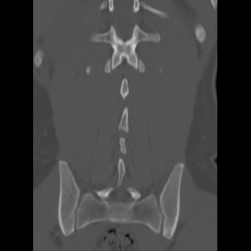 Clear cell meningoma - lumbar spine (Radiopaedia 60116-67691 Axial bone window 1).png