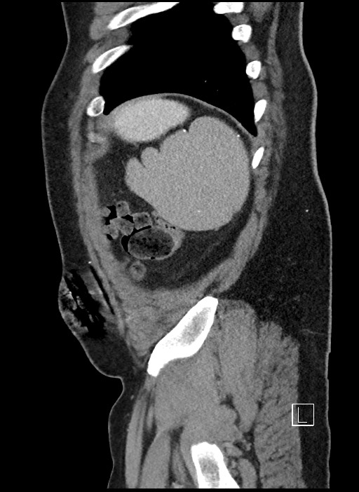 Closed loop obstruction - internal hernia into nephrectomy bed (Radiopaedia 59867-67320 C 4).jpg