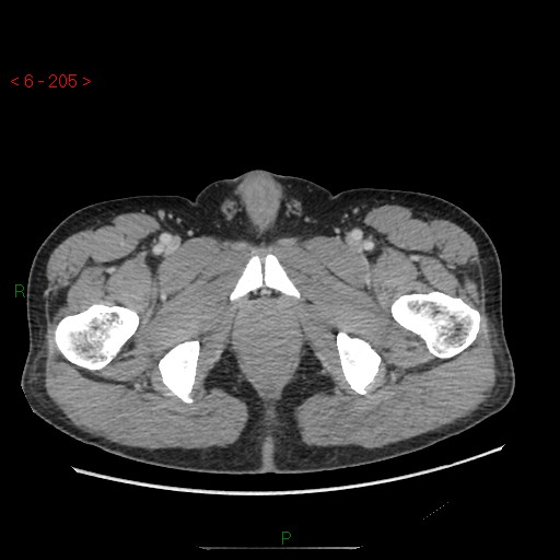 File:Closed loop obstruction and appendicular stump mucocele (Radiopaedia 54014-60163 A 125).jpg