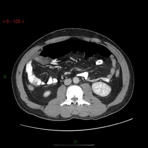 File:Closed loop obstruction and appendicular stump mucocele (Radiopaedia 54014-60163 A 57).jpg