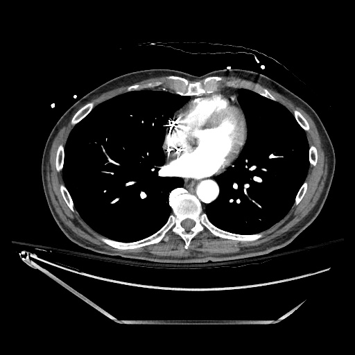 File:Closed loop obstruction due to adhesive band, resulting in small bowel ischemia and resection (Radiopaedia 83835-99023 B 5).jpg