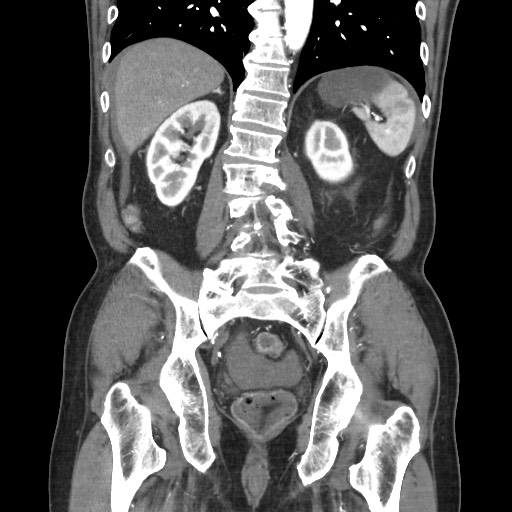 File:Closed loop obstruction due to adhesive band, resulting in small bowel ischemia and resection (Radiopaedia 83835-99023 C 87).jpg