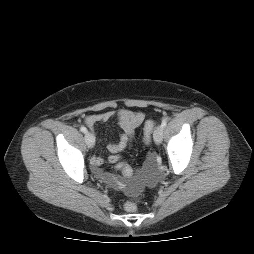File:Closed loop small bowel obstruction (Radiopaedia 65403-74451 Axial 46).jpg