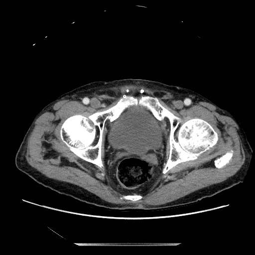 File:Closed loop small bowel obstruction - adhesive disease and hemorrhagic ischemia (Radiopaedia 86831-102990 A 167).jpg