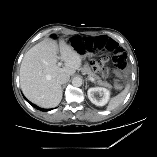 Closed loop small bowel obstruction - omental adhesion causing "internal hernia" (Radiopaedia 85129-100682 A 32).jpg
