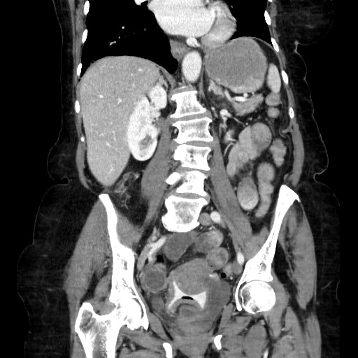 Closed loop small bowel obstruction due to adhesive band, with intramural hemorrhage and ischemia (Radiopaedia 83831-99017 C 73).jpg