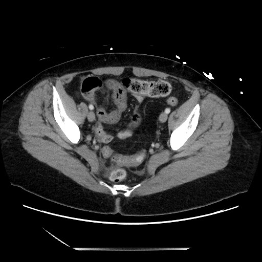 Closed loop small bowel obstruction due to adhesive bands - early and late images (Radiopaedia 83830-99014 A 128).jpg