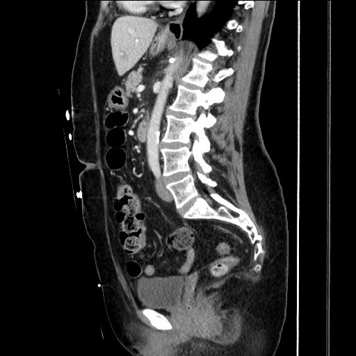 File:Closed loop small bowel obstruction due to adhesive bands - early and late images (Radiopaedia 83830-99014 C 100).jpg