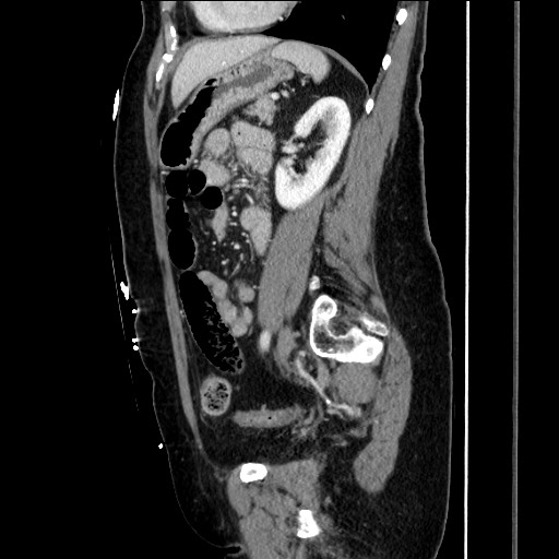 Closed loop small bowel obstruction due to adhesive bands - early and late images (Radiopaedia 83830-99014 C 118).jpg