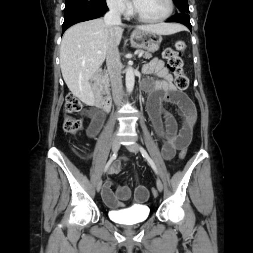 File:Closed loop small bowel obstruction due to adhesive bands - early and late images (Radiopaedia 83830-99015 B 62).jpg