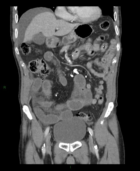 Closed loop small bowel obstruction with ischemia (Radiopaedia 84180-99456 B 43).jpg