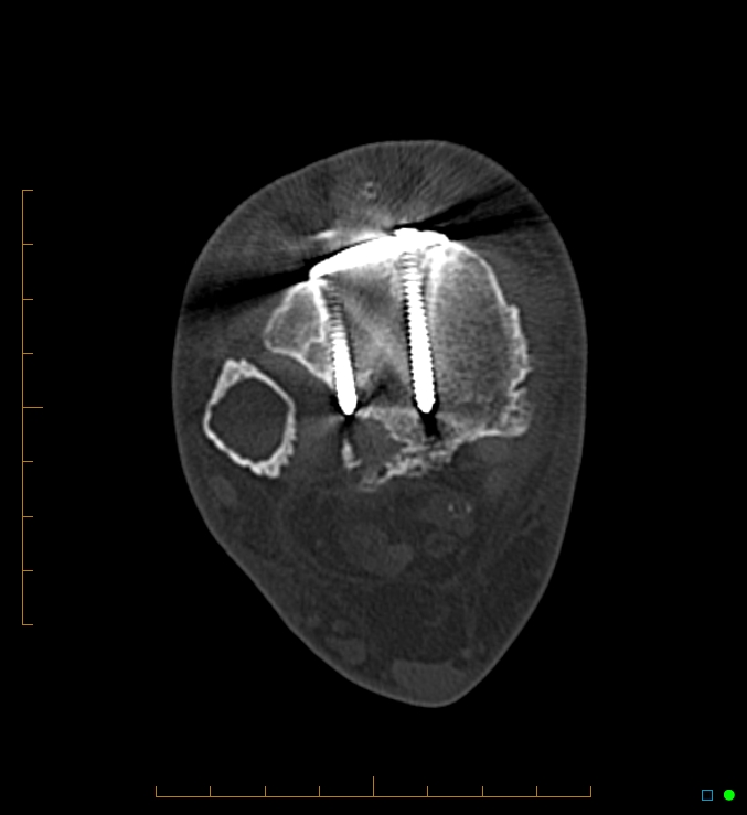 Collapsed total ankle replacement (Radiopaedia 17228-16932 Axial bone window 7).jpg
