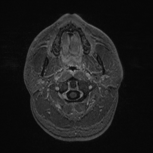 File:Colloid cyst (Radiopaedia 44510-48181 Axial T1 C+ 13).png