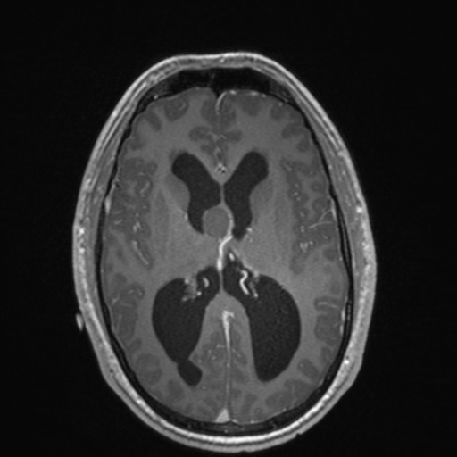 File:Colloid cyst (Radiopaedia 44510-48181 Axial T1 C+ 99).png