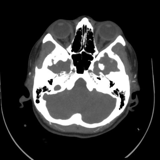 File:Colloid cyst (resulting in death) (Radiopaedia 33423-34499 A 13).png