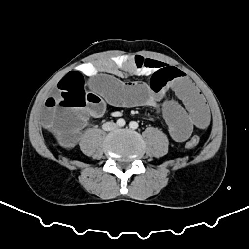 Colocolic intussusception due to large lipoma (Radiopaedia 68773-78482 A 117).jpg