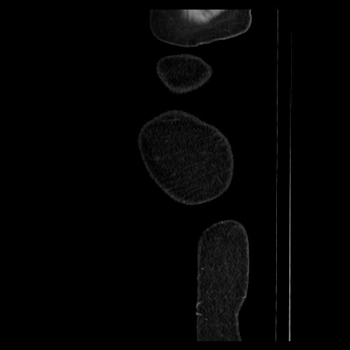 Colocolic intussusception due to tubular adenoma (Radiopaedia 73744-84551 C 12).jpg