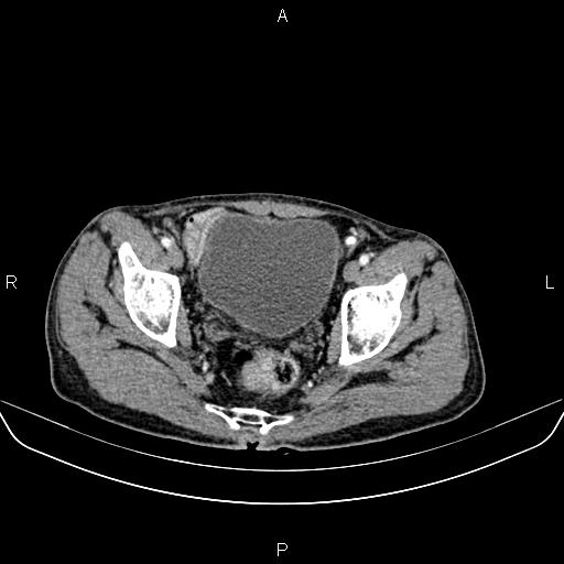 File:Colon adenocarcinoma - hepatic flexure (Radiopaedia 85635-101395 A 86).jpg
