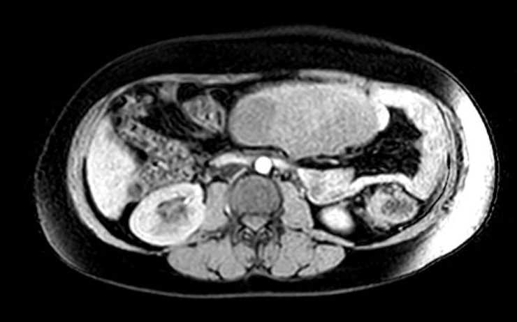 Colon adenocarcinoma with Krukenberg tumors, advanced pregnancy (Radiopaedia 67279-76645 A 47).jpg