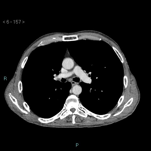 Colonic cancer (ultrasound and TC imaging) (Radiopaedia 50346-55713 B 157).jpg