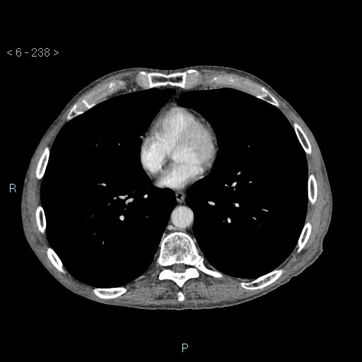 Colonic cancer (ultrasound and TC imaging) (Radiopaedia 50346-55713 B 238).jpg