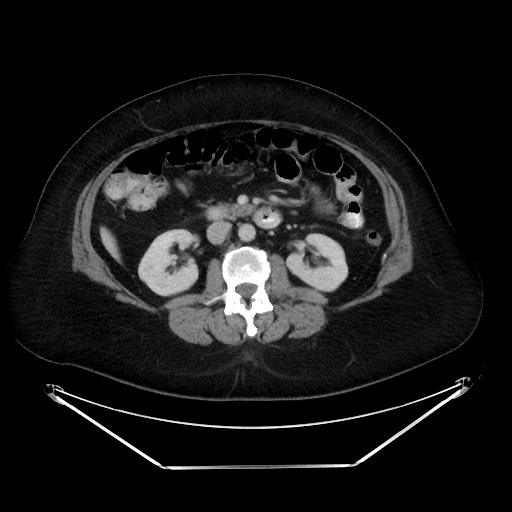 File:Colonic intussusception due to adenocarcinoma (Radiopaedia 86828-102987 A 68).jpg