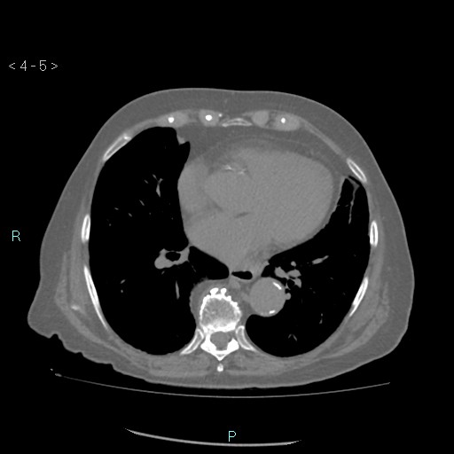 File:Colonic lipomas (Radiopaedia 49137-54244 Axial bone window 3).jpg