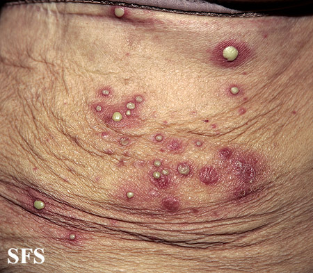 File:Impetigo (Dermatology Atlas 53).jpg