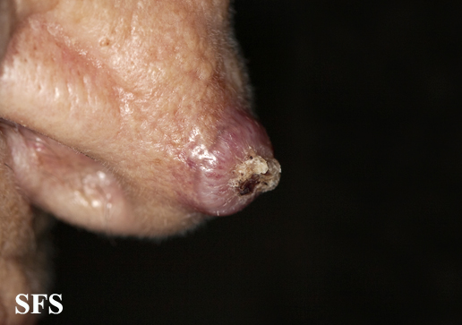 File:Keratoacanthoma (Dermatology Atlas 65).jpg