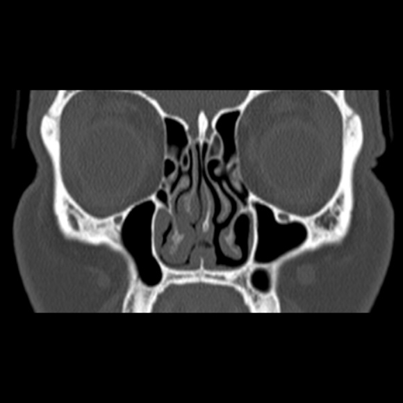 Nasal septal perforation (Radiopaedia 25030-25289 Coronal bone window 27).jpg