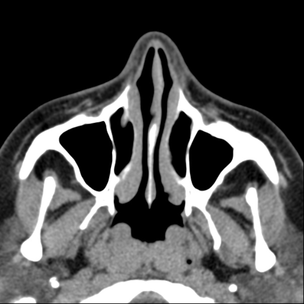 Nasolabial cyst (Radiopaedia 33987-35205 Axial non-contrast 16).jpg