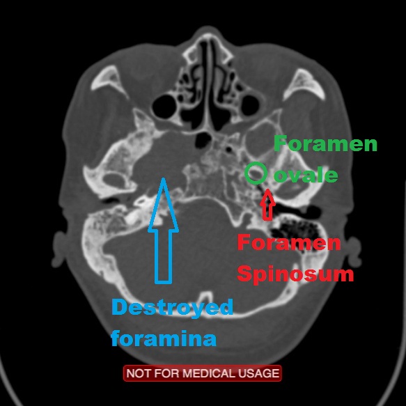 File:Nasopharyngeal carcinoma recurrence - skull base destruction (Radiopaedia 29107-30461 C 1).jpg