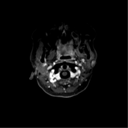File:Nasopharyngeal carcinoma with cerebral abscess (Radiopaedia 43018-46274 Axial T1 C+ fat sat 5).png