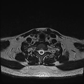 Nasopharyngeal carcinoma with perineural spread (Radiopaedia 55030-61380 Axial T2 77).jpg