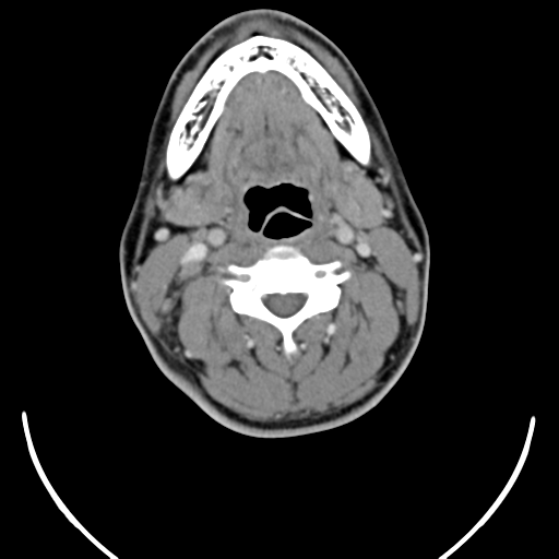 File:Nasopharyngeal carcinoma with pterygopalatine fossa involvement (Radiopaedia 33102-34132 A 32).png