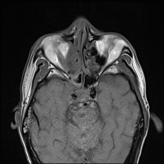 Nasopharyngeal carcinoma with skull base invasion (Radiopaedia 59258-66600 B 10).jpg