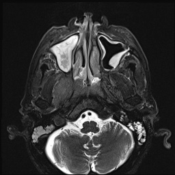 File:Nasopharyngeal carcinoma with skull base invasion (Radiopaedia 59258-66600 D 18).jpg