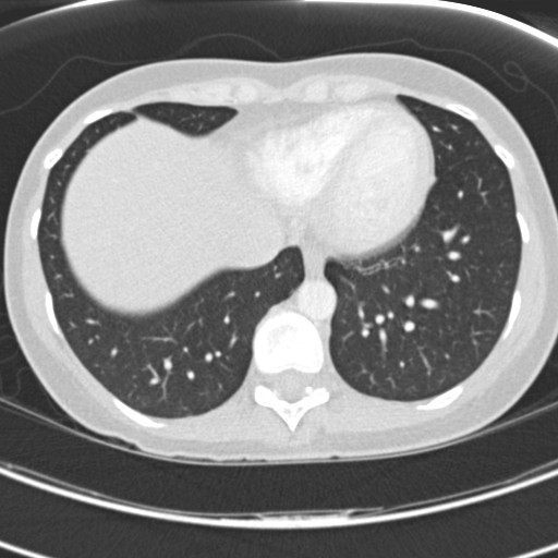 File:Necrobiotic pulmonary nodules - Crohn disease (Radiopaedia 20723-20631 Axial lung window 110).jpg
