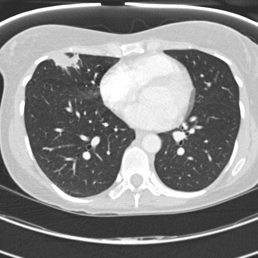File:Necrobiotic pulmonary nodules - Crohn disease (Radiopaedia 20723-20631 Axial lung window 89).jpg