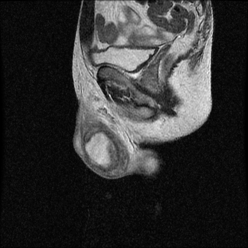 File:Necrotizing epididymo-orchitis with intra-testicular abscess (Radiopaedia 29397-29860 Sagittal T2 13).jpg
