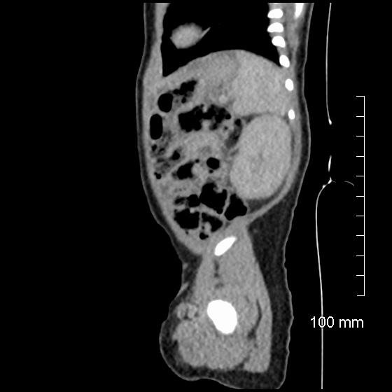 File:Neonatal neuroblastoma (Radiopaedia 56651-63438 C 24).jpg