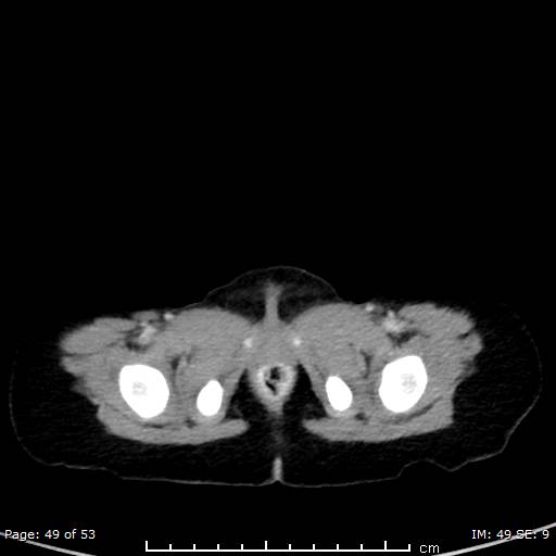 Nephroblastomatosis (Radiopaedia 41934-44935 A 49).jpg