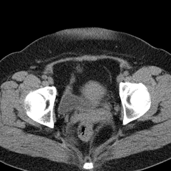 File:Nephrostomy for urosepsis (Radiopaedia 26180-26330 Axial non-contrast 63).jpg