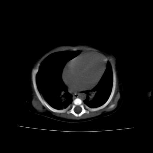 File:Neuroblastoma (Radiopaedia 20876-20799 Axial non-contrast 1).jpg