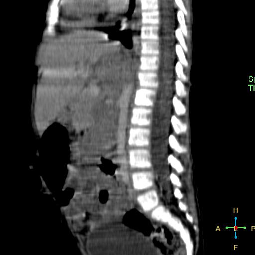 File:Neuroblastoma (Radiopaedia 24751-25016 C 14).jpg