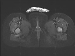 File:Neuroblastoma with bone metastases (Radiopaedia 67080-76414 Axial STIR 40).jpg