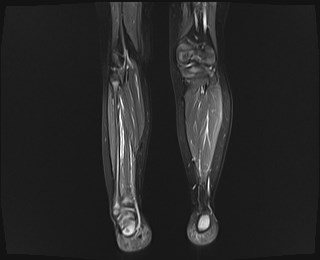 File:Neuroblastoma with bone metastases (Radiopaedia 67080-76414 B 12).jpg