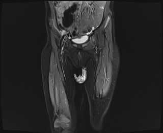 File:Neuroblastoma with bone metastases (Radiopaedia 67080-76414 Coronal STIR 6).jpg